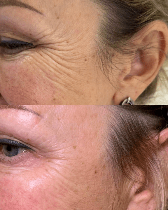 anti wrinkle injections at sorelle skin clinic