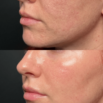 Is Microneedling Worth It?