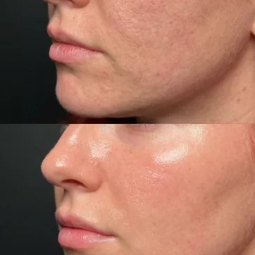The Best Treatments for Acne Scars in Birmingham (2026 Guide)