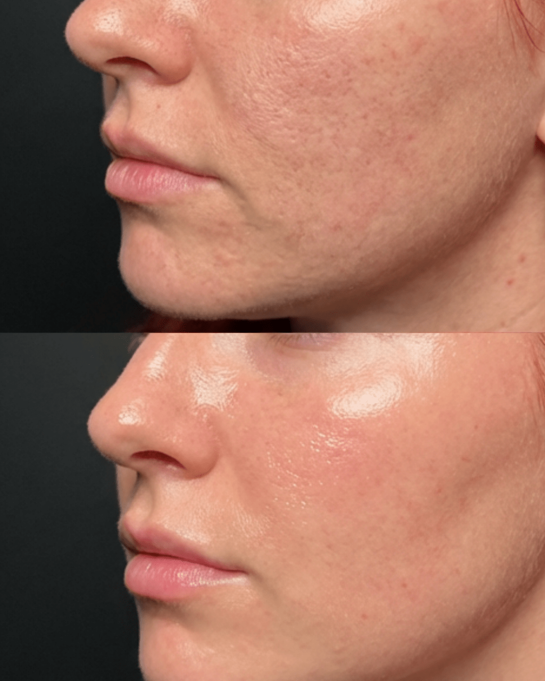 The Best Treatments for Acne Scars in Birmingham (2026 Guide)