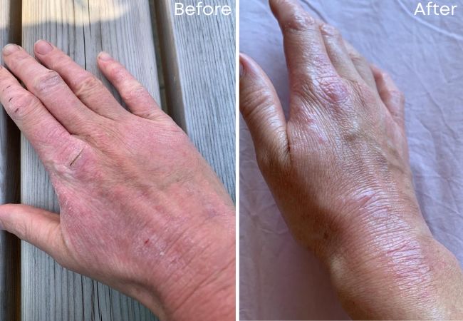 COLD PLASMA RESULTS BIRMINGHAM