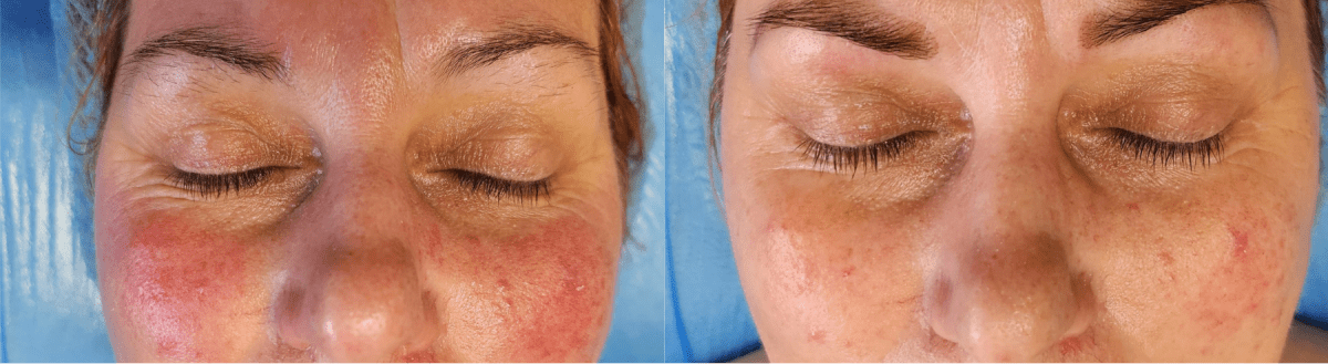 dr platon cold plasma treatment Birmingham