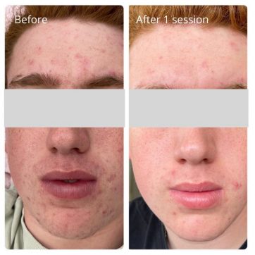 cold plasma acne treatment