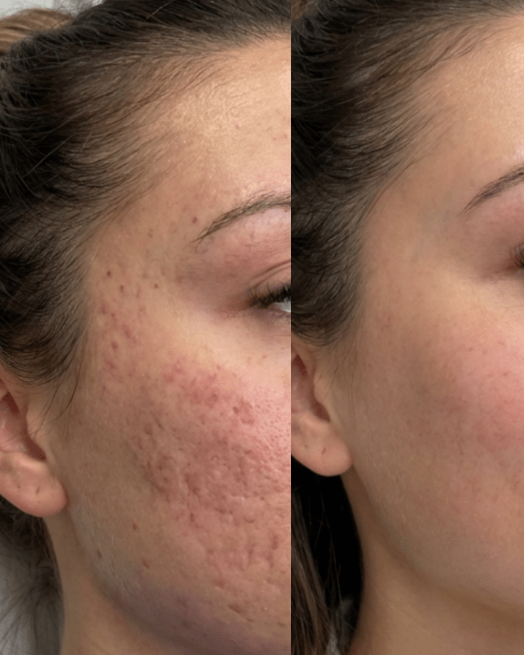 SORELLE SKIN CLINIC BEFORE AND AFTER