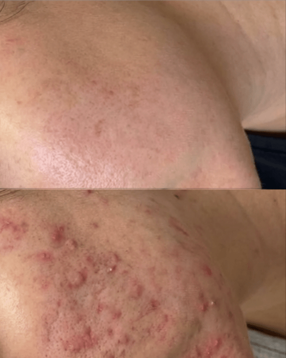 microneedling for acne scars