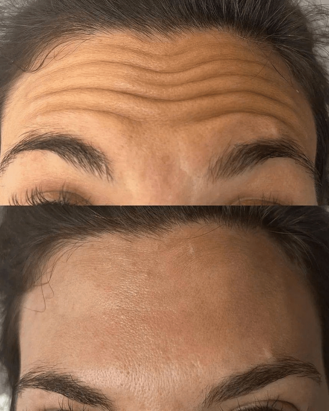 anti wrinkle injections results birmingham