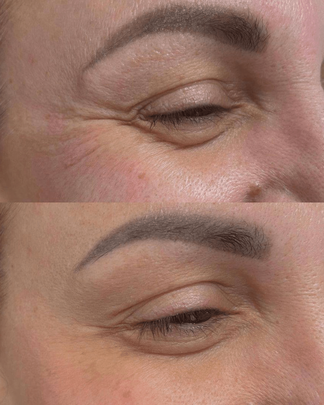 anti wrinkle injections results birmingham