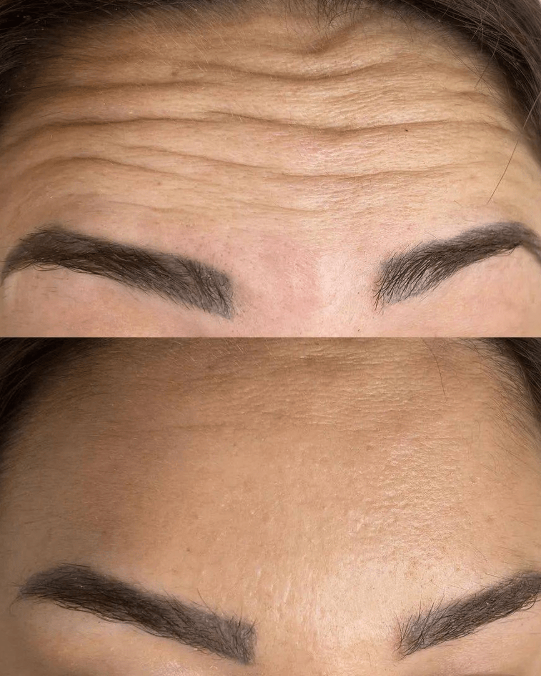 anti wrinkle injections results birmingham