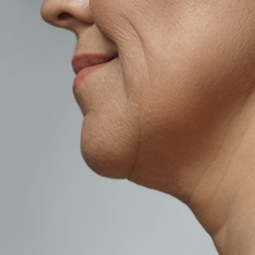 Tear Troughs and Under Eye Hollows: the No Filler Options