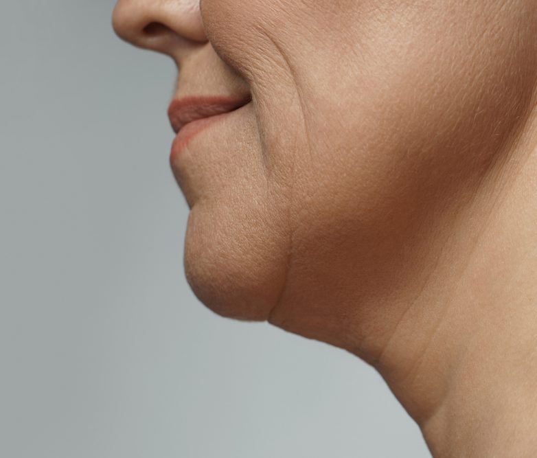 How to Get Rid of Jowls Without Surgery