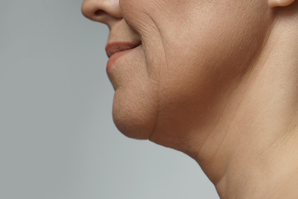 How to Get Rid of Jowls Without Surgery