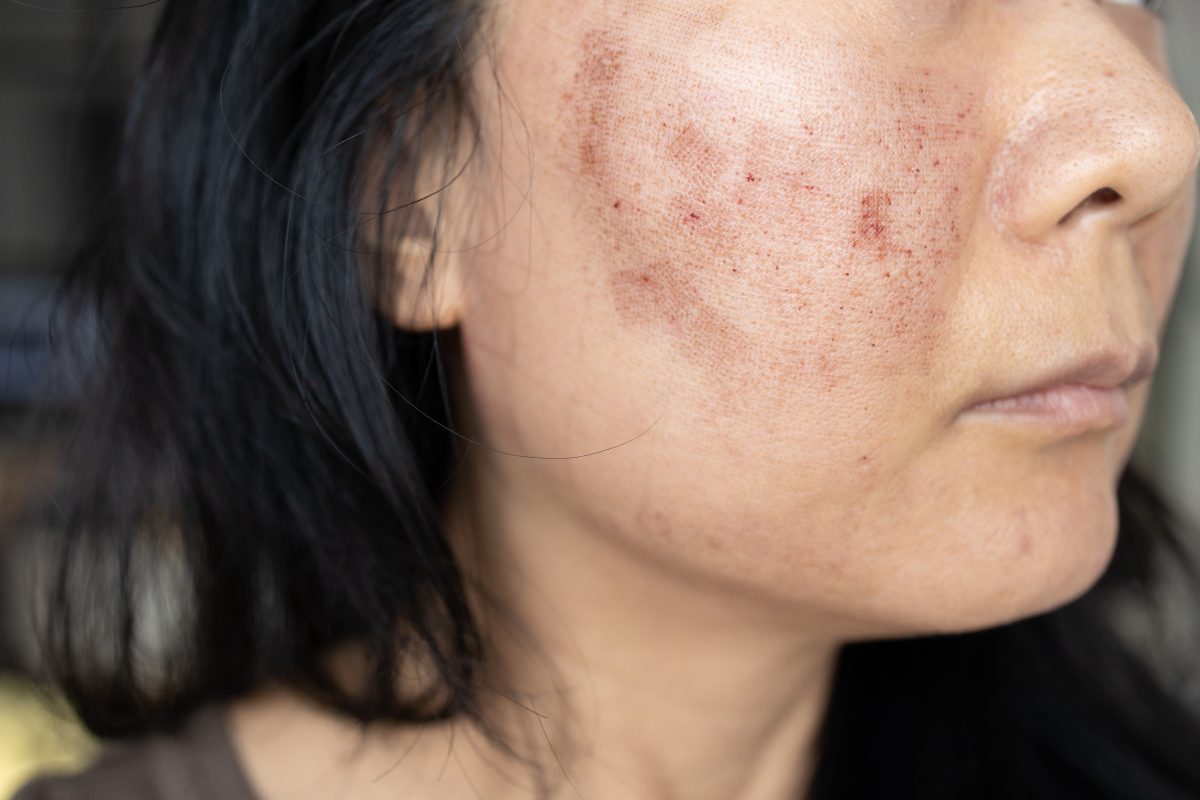 why melasma and pigmentation shows after 40