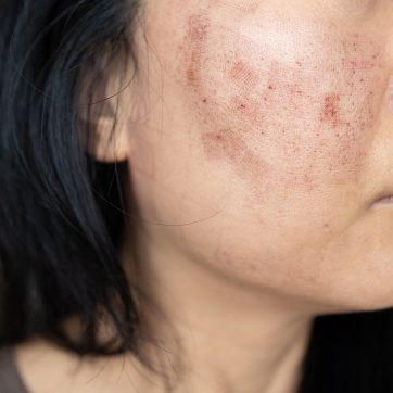 Tear Troughs and Under Eye Hollows: the No Filler Options