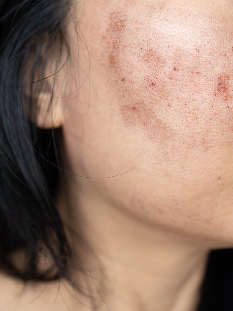 Melasma and Pigmentation: Why It Shows Up in Your 40s (and How to Treat It)