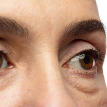 Melasma and Pigmentation: Why It Shows Up in Your 40s (and How to Treat It)