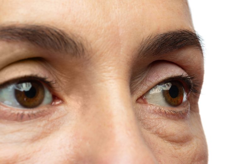 Tear Troughs and Under Eye Hollows: the No Filler Options