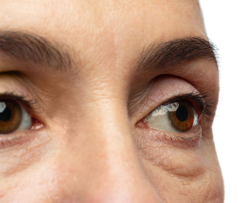 Tear Troughs and Under Eye Hollows: the No Filler Options