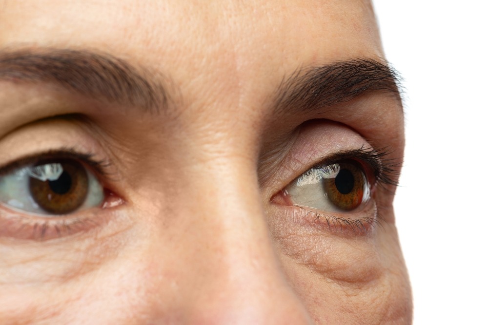 Tear Troughs and Under Eye Hollows: the No Filler Options